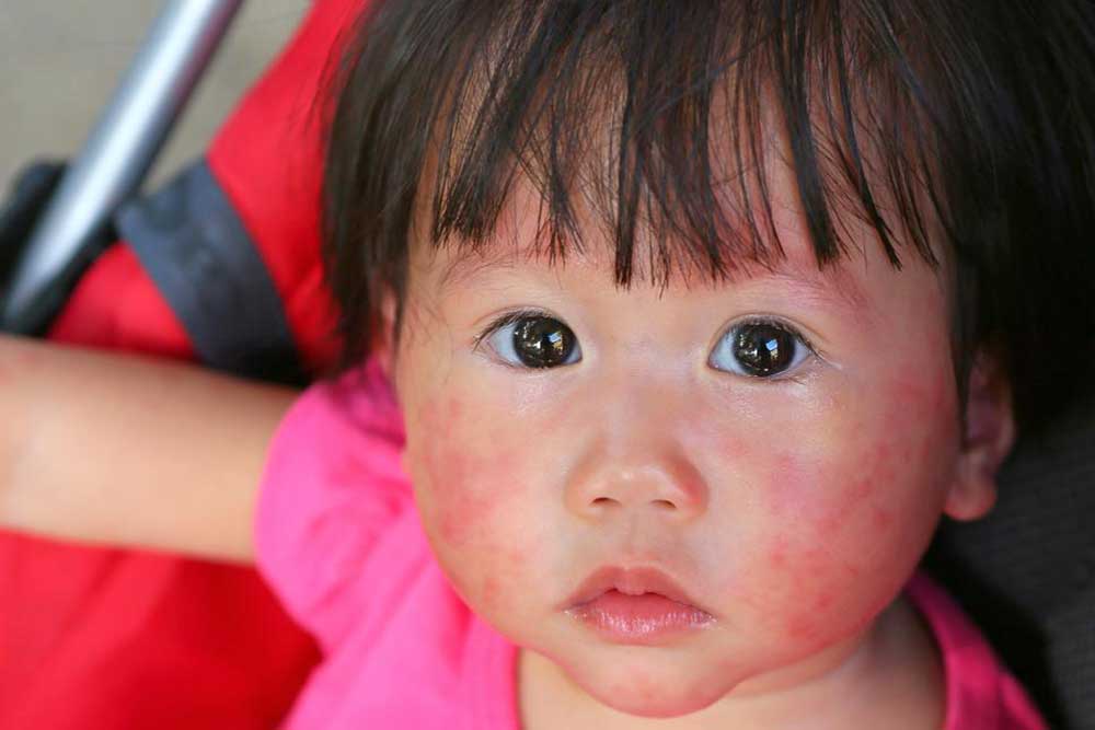 Skin Rashes – Common Types and Causes